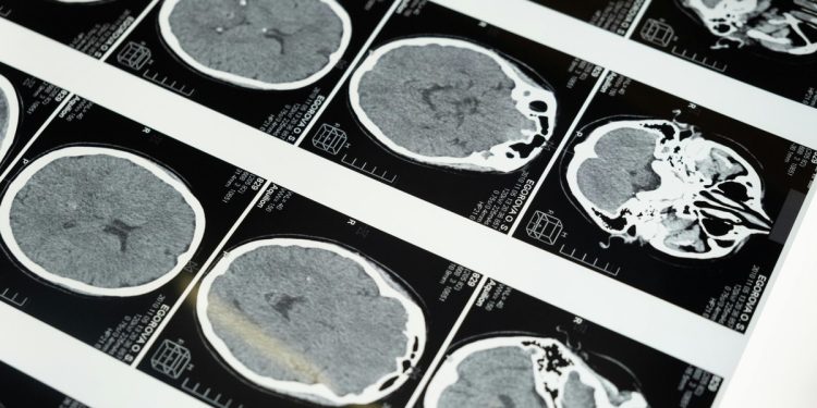 Por que o cérebro decide desistir antes do limite real de esforço? Estudo com imagens cerebrais mostra as razões