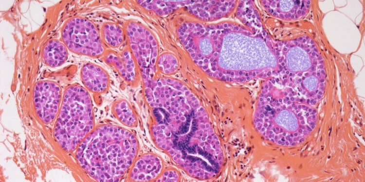 Nova estratégia contra células tumorais dormentes pode impedir retorno do câncer de mama, dizem cientistas