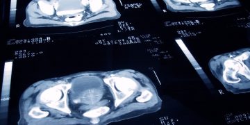 Cirurgia de precisão contra câncer de próstata: novo tratamento mira só tumor e reduz riscos de impotência