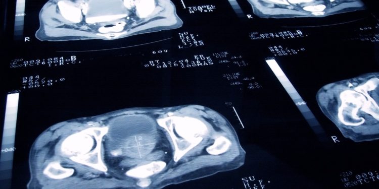 Cirurgia de precisão contra câncer de próstata: novo tratamento mira só tumor e reduz riscos de impotência